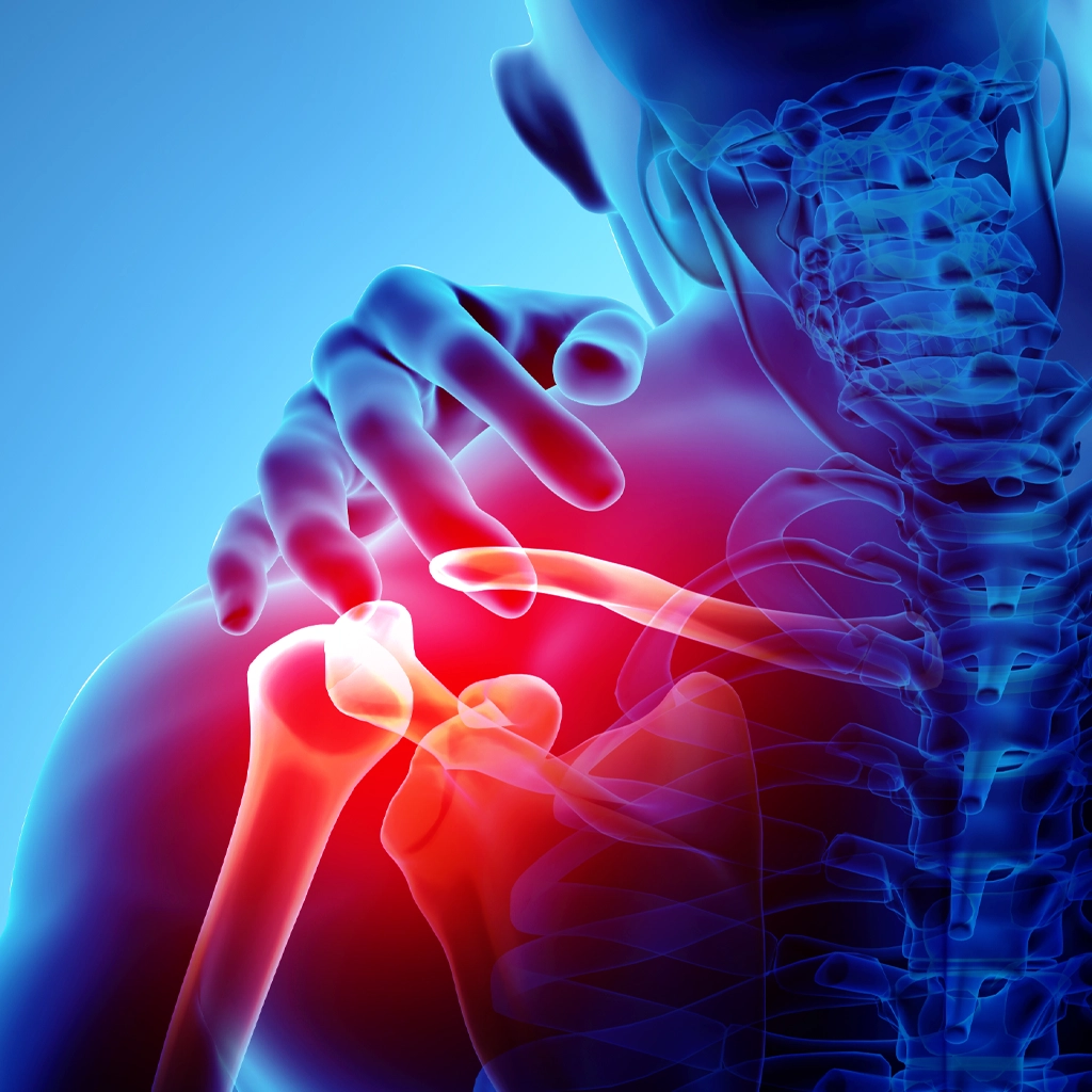 Frozen Shoulder Embolization (FSE)
