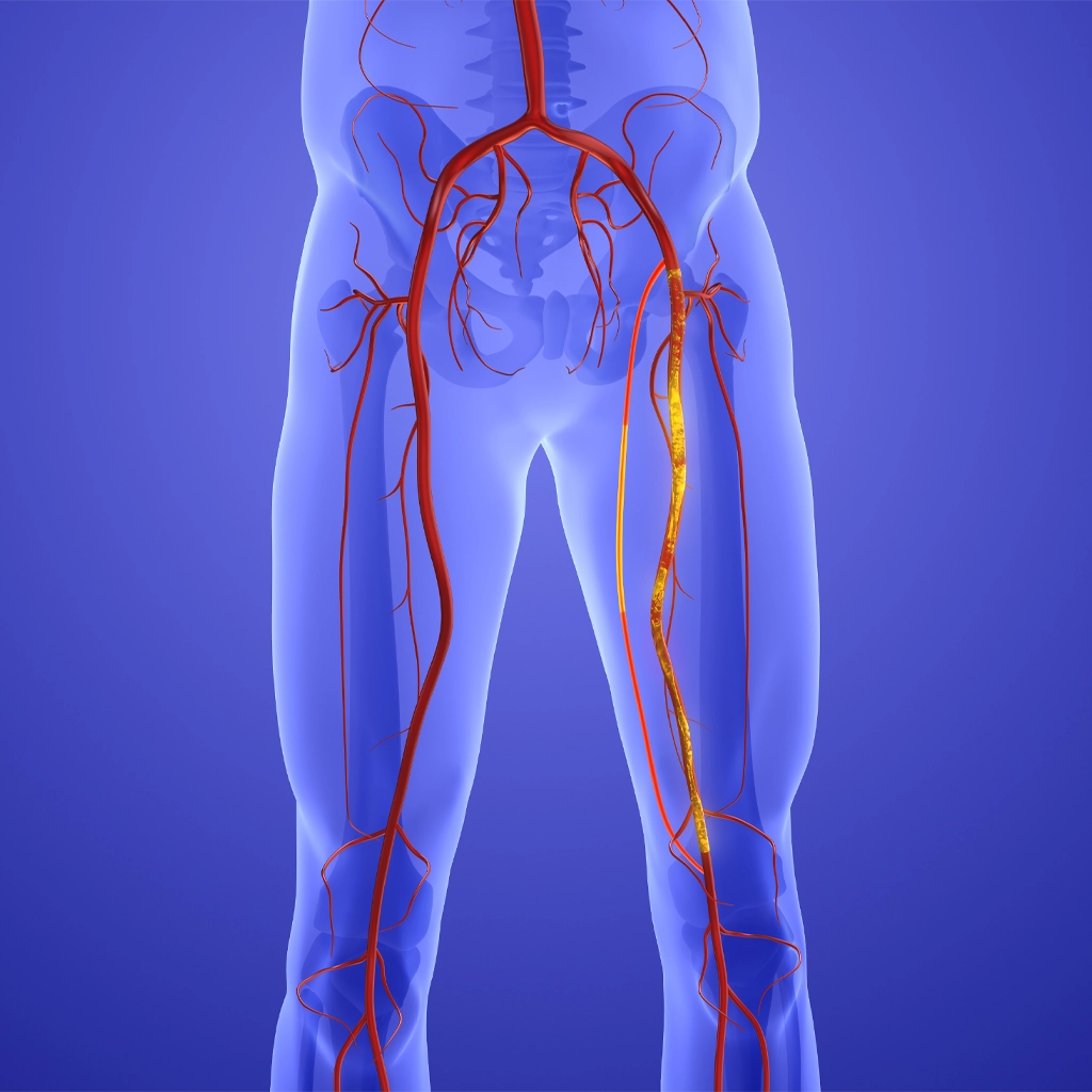 Vascular Disease, Endovascular Treatment