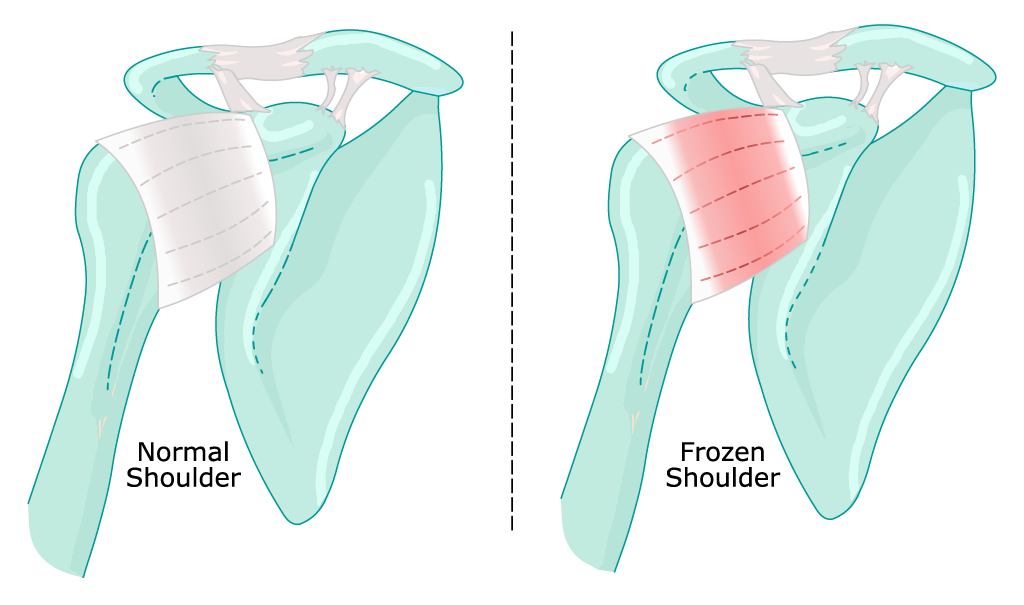 normal shoulder versus frozen shoulder