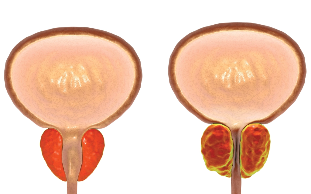 normal prostate versus enlarged prostate