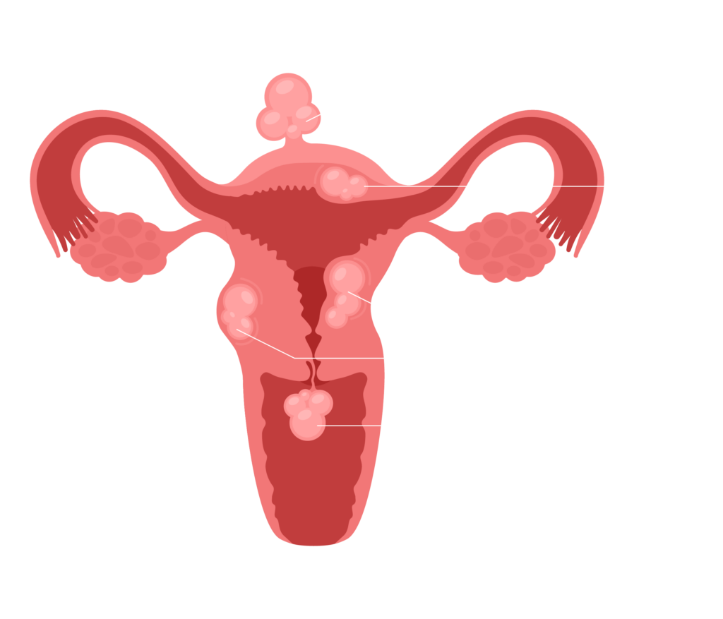 types of fibroids
