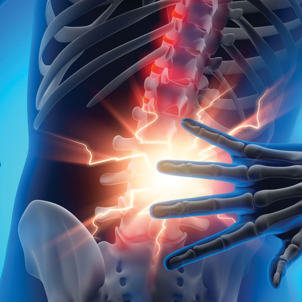 Spine Pain Needing Vertebral Augmentation Illustration